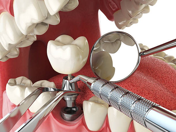 Best Emergency Treatment for Toothache in Parker, CO